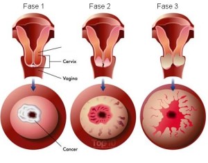 sintomas cancer cuello utero