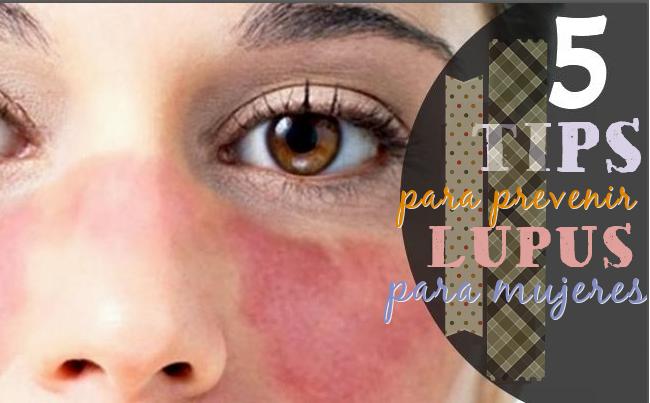 5 tips prevenir lupus mujeres